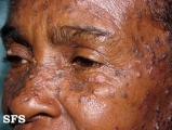 lupus erythematosus chronicus disseminatus superficialis