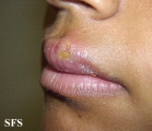 herpes simplex