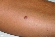 dermatofibroma