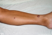 dermatofibroma