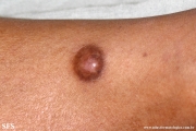 dermatofibroma