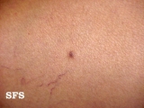 dermatofibroma