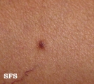 dermatofibroma