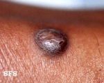 dermatofibroma
