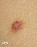 dermatofibroma