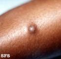 dermatofibroma