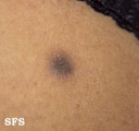 dermatofibroma