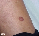 dermatofibroma