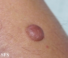 dermatofibroma