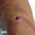 granuloma pyogenic