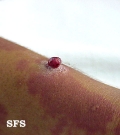 granuloma pyogenic
