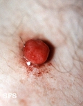 granuloma pyogenic