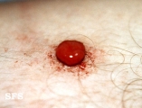 granuloma pyogenic