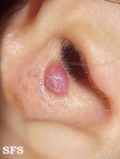 granuloma pyogenic