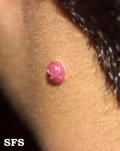 granuloma pyogenic