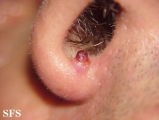granuloma pyogenic