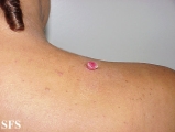 granuloma pyogenic