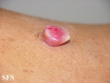 granuloma pyogenic