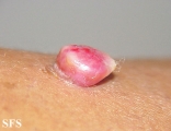 granuloma pyogenic