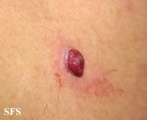 granuloma pyogenic