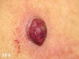 granuloma pyogenic