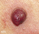 granuloma pyogenic