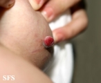 granuloma pyogenic