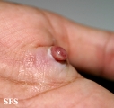 granuloma pyogenic