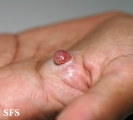 granuloma pyogenic