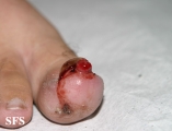 granuloma pyogenic