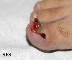 granuloma pyogenic