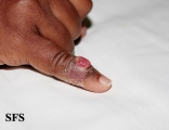granuloma pyogenic