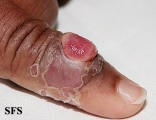 granuloma pyogenic