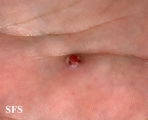 granuloma pyogenic