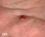 granuloma pyogenic