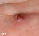 granuloma pyogenic