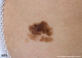 lentigo maligna-melanoma