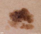 lentigo maligna-melanoma