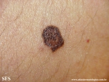 lentigo maligna-melanoma