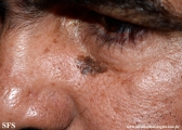 lentigo maligna-melanoma