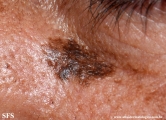 lentigo maligna-melanoma