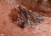 lentigo maligna-melanoma
