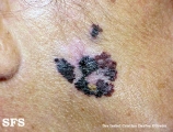 lentigo maligna-melanoma