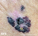 lentigo maligna-melanoma