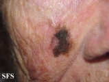 lentigo maligna-melanoma