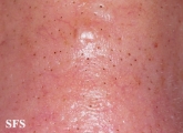 trichostasis_spinulosa