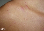 eosinophilic folliculitis of hiv aids