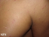 eosinophilic folliculitis of hiv aids