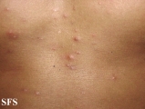eosinophilic folliculitis of hiv aids