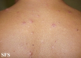 eosinophilic folliculitis of hiv aids